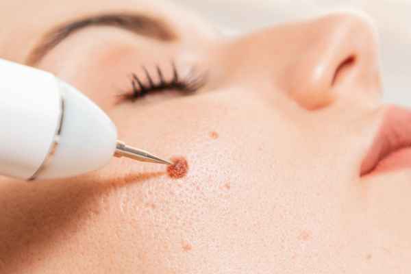 CryoPen: 5 Skin Concerns It May Be Used to Treat 3 What actually happens during a CryoPen treatment Kington?