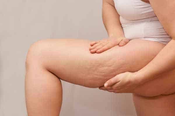 Find the best cellulite treatment Kington for you!