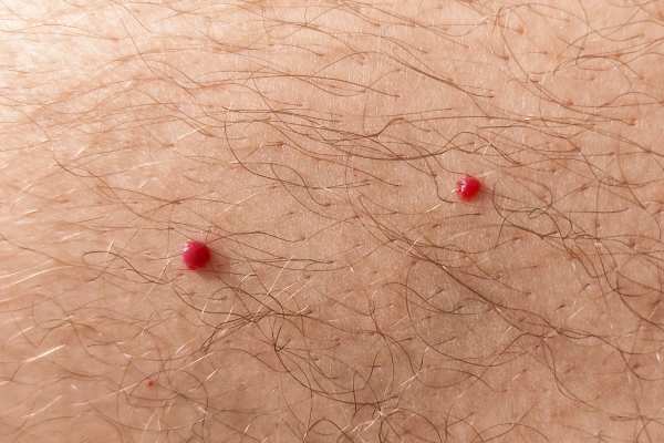 CryoPen: 5 Skin Concerns It May Be Used to Treat 2 cherry angioma removal Kington