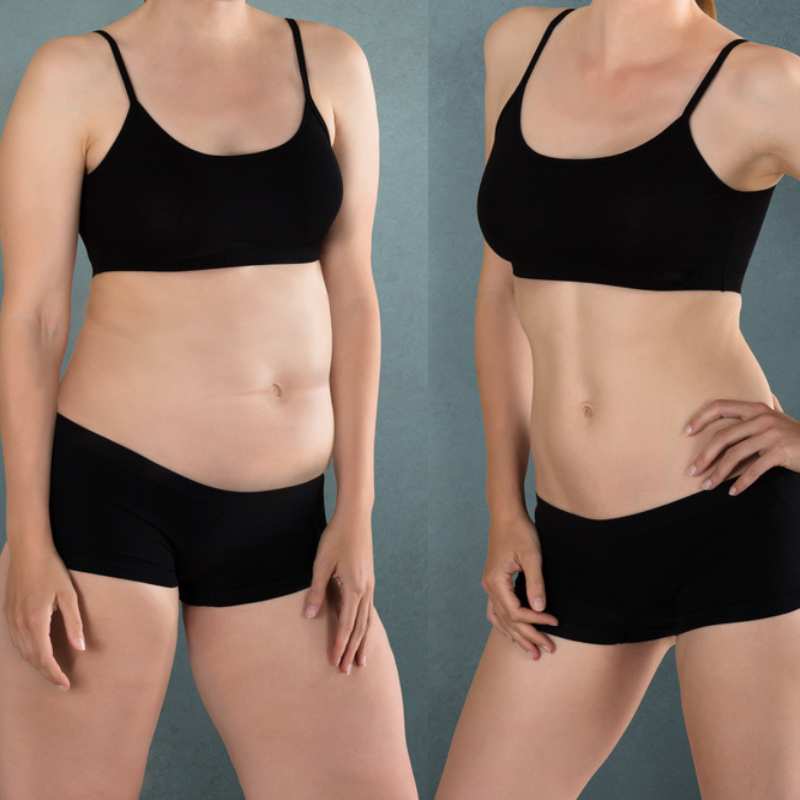 Does Fat Freezing at Home Work? DIY Devices vs Professional Cryolipolysis 2 before and after Cryolipolysis Kington