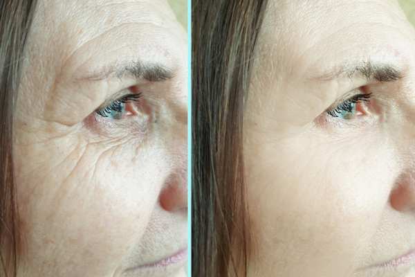 Why Do People Choose HIFU for a Non-Surgical Facelift? 4 How long can HIFU results last Kington?