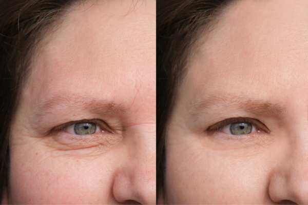 HIFU vs Botulinum Toxin: Understanding the Differences 4 How long do HIFU results last Kington?