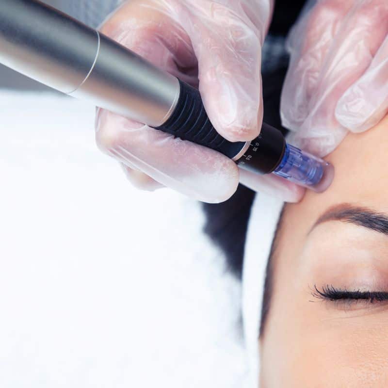 Morpheus8 treatment Kington from Lipo Sculpt - Book in today!