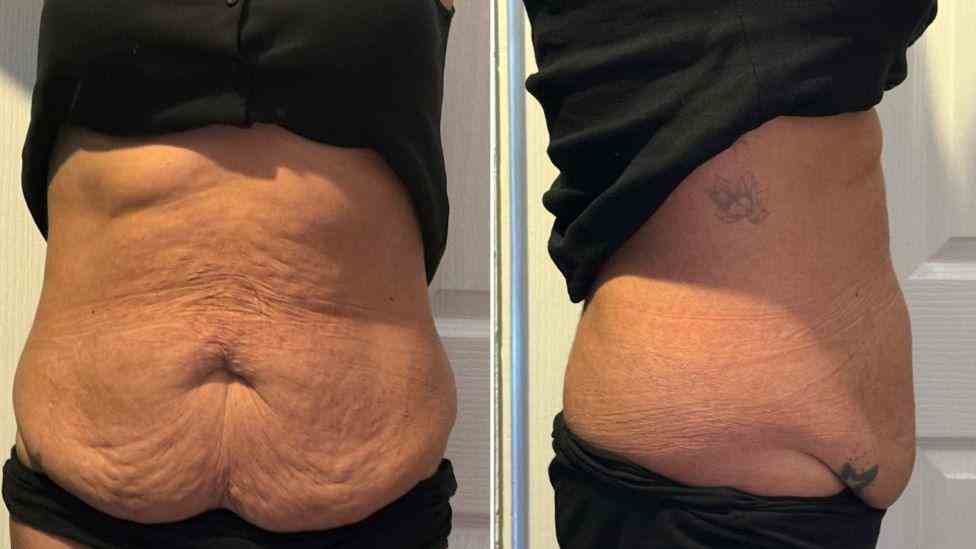 Lost the Weight but Not the Loose Skin? What You Should Know 1 Is It Definitely Loose Skin Kington?